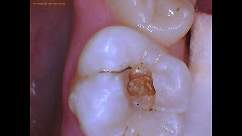 The real root cause of bleeding gums and tooth decay