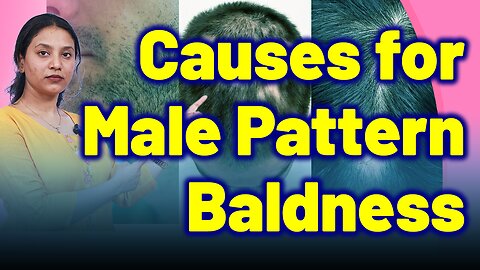 Causes for Male Pattern Baldness | Treatment and Cure | Homeopathy