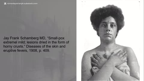 The Truth About Smallpox – A Fraudulent Scheme to Justify Vaccines