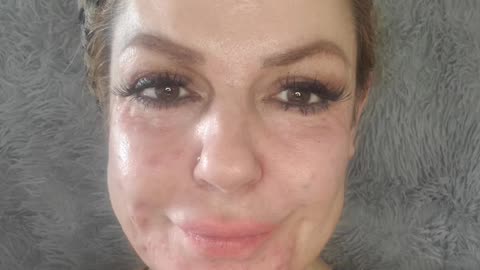 DIY- at Home PDRN Mesotherapy