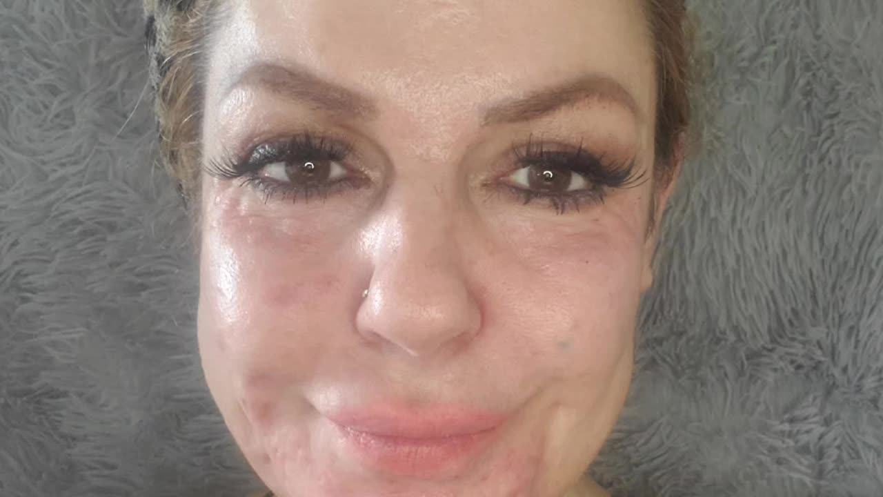 DIY- at Home PDRN Mesotherapy