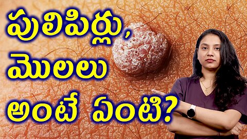 పులిపిర్లు, మొలలు అంటే ఏంటి? What is Wart or Skintags ?Warts Homeopathy Treatment హోమియోపతి