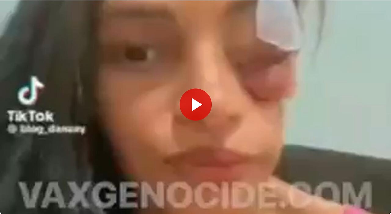 Horrible Vaxx side effect in a young woman - here's looking at you...sort of. 💉😳