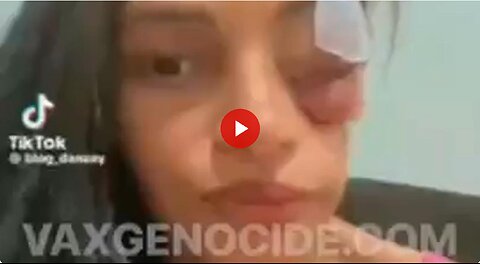 Horrible Vaxx side effect in a young woman - here's looking at you...sort of. 💉😳