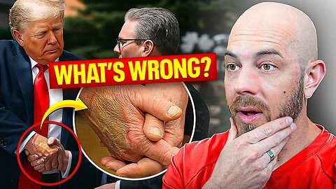 Dermatologist Explains Trump’s Hand