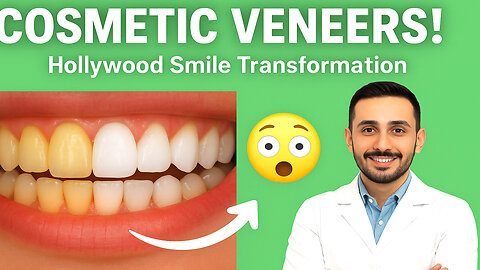 Cosmetic dental veneers to correct tooth discoloration and crookedness