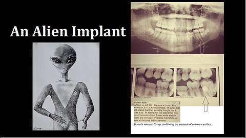AN ALIEN IMPLANT