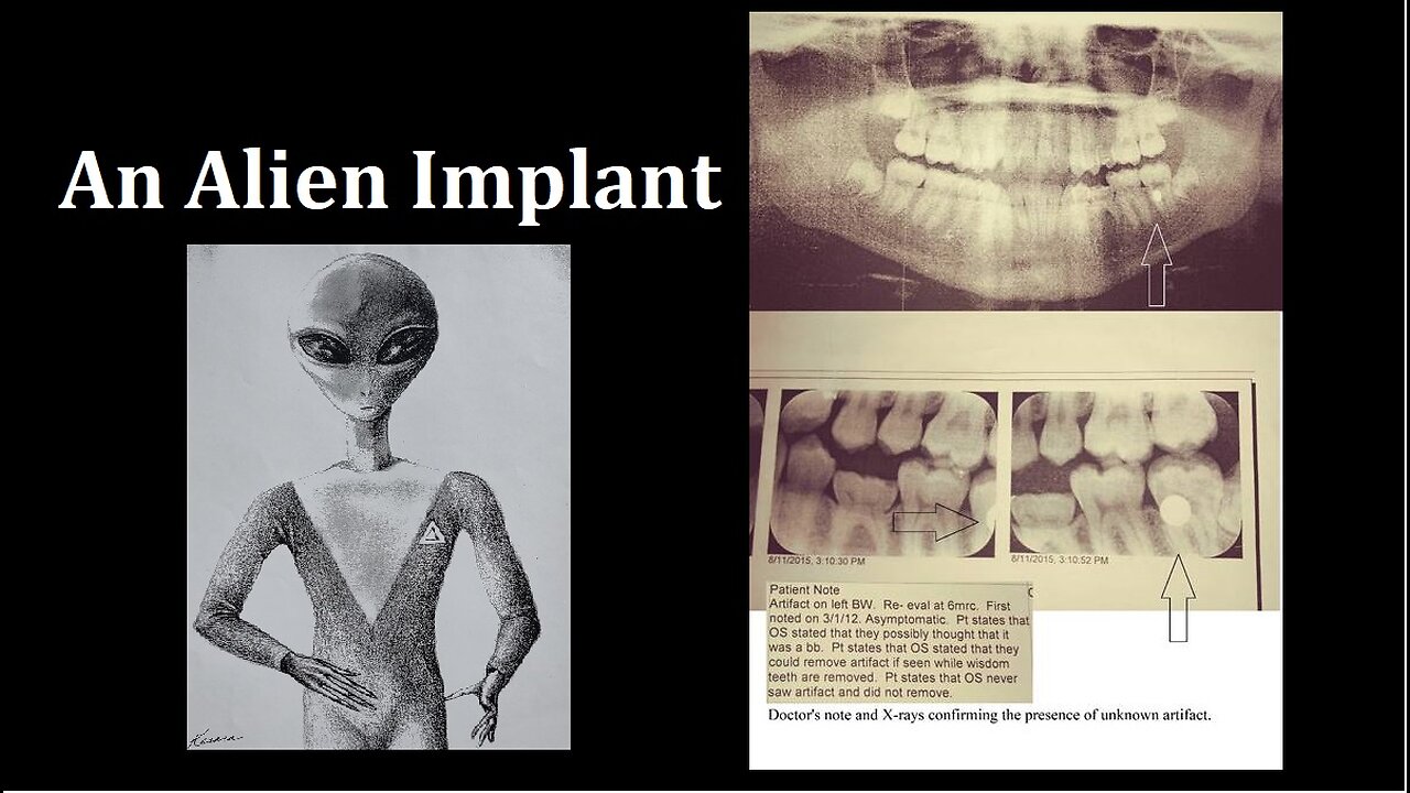 AN ALIEN IMPLANT