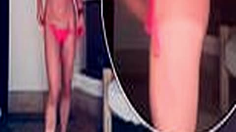 Britney Spears Shows Off Painful Sunburn in a Brig