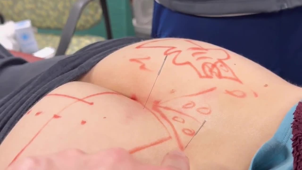Back Spasm? Low Back Pain? Fix it with Dry Needling!