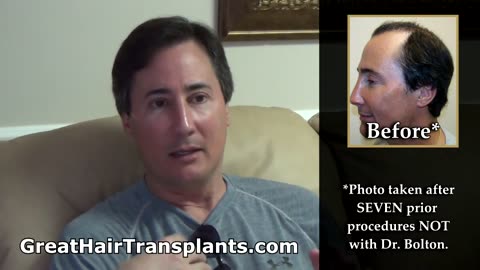 Dr. Brett Bolton Corrective Hair Transplant Transformation