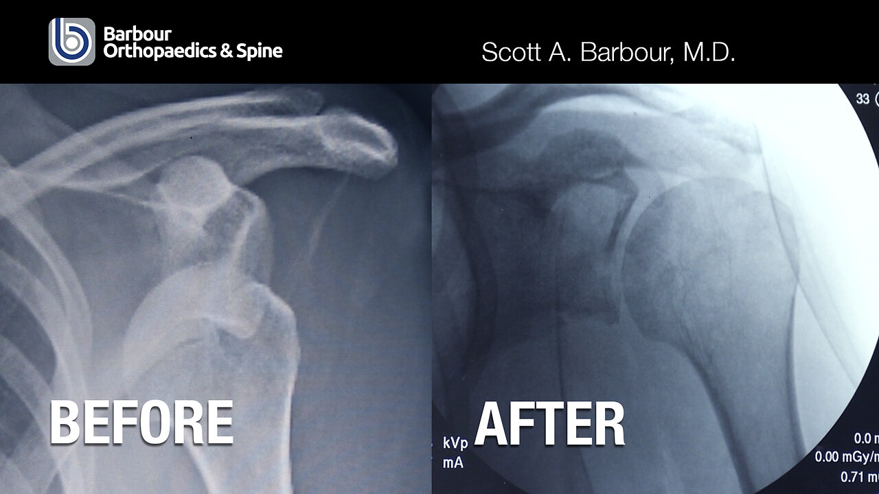 🦴 Get a-HEAD of the Game! Dr. Barbour Tackles a Tricky Hip Dislocation 💪⚙️ #OrthoHero