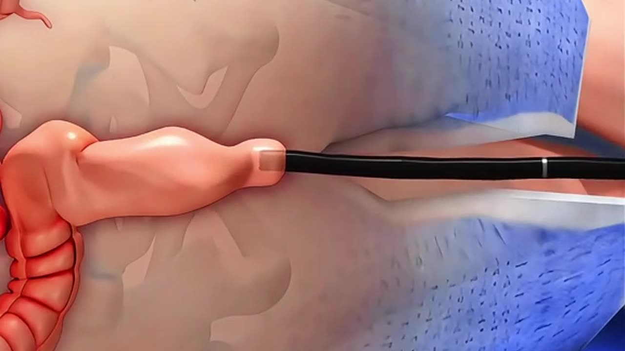 Colonoscopy Procedure (3D Animation)
