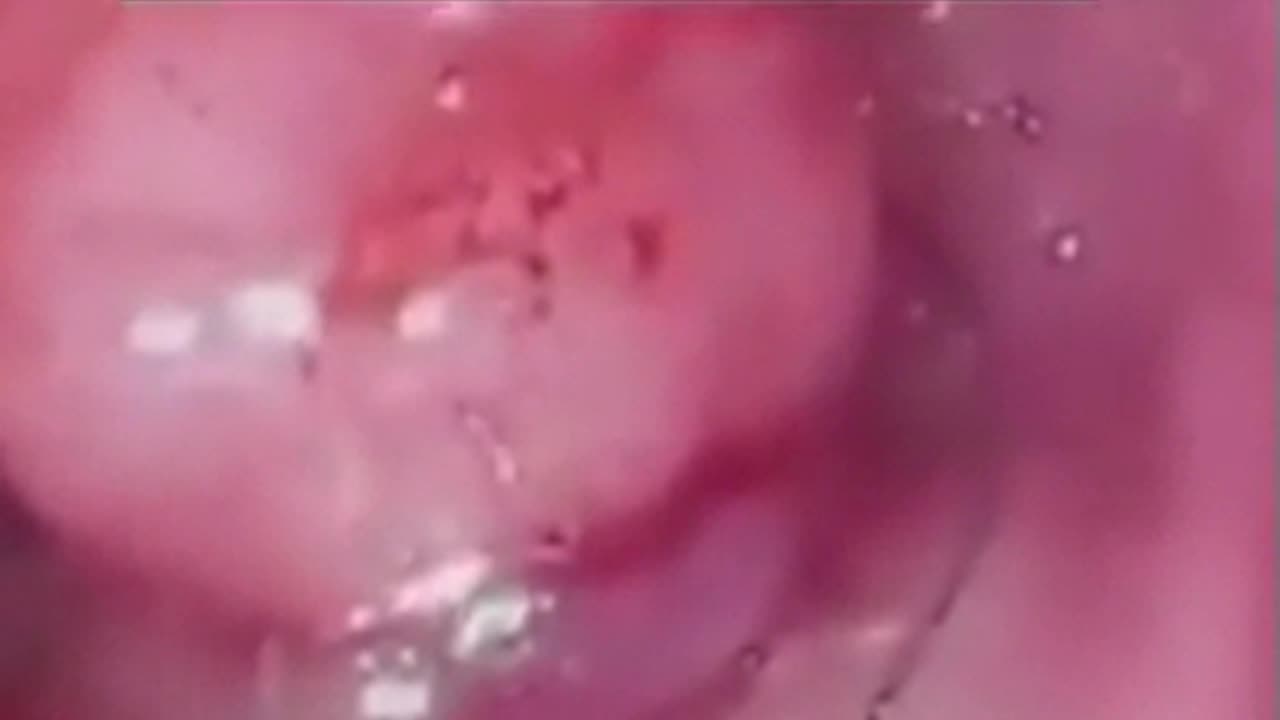 Tumors Cancer Parasites | Ward Dean MD