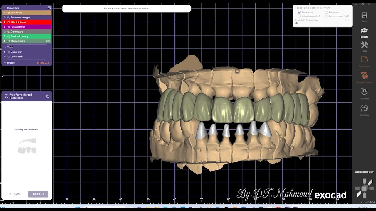 #design #naildesign #dental #dentaldesign #exocadexpert