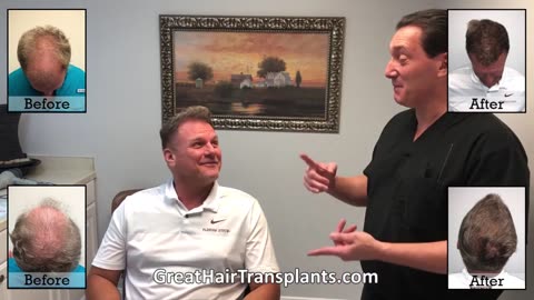 Tom’s MaxHarvest™ Plus Hair Transplant Results by Dr. Brett Bolton