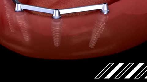 Print Perfecto – Advanced 3D Printed Dental Implants