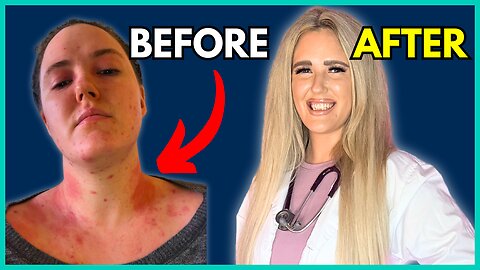 Can the Carnivore Diet Heal Your Food Sensitivities?