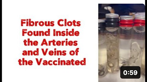 "Vaccinated Individuals Found with Fibrous Clots in Arteries and Veins"