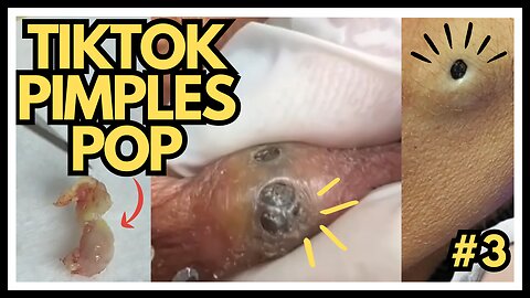 TIKTOK PIMPLES #3