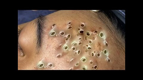 blackhead removal and Pimplepopper Spa relaxation #1012
