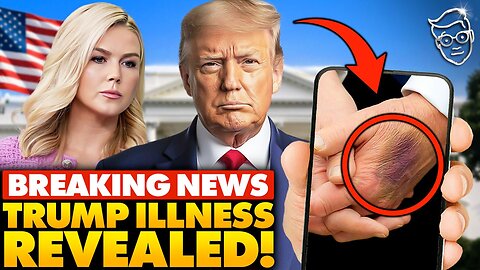 🚨White House Makes SHOCK Announcement on Trump’s Health After 'Bruising' Photos Go VIRAL: "Doctors...