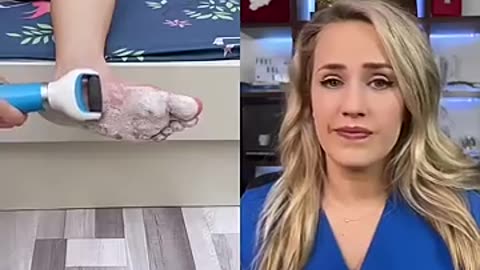 Incredible: Doctor reacts to callus shaving device