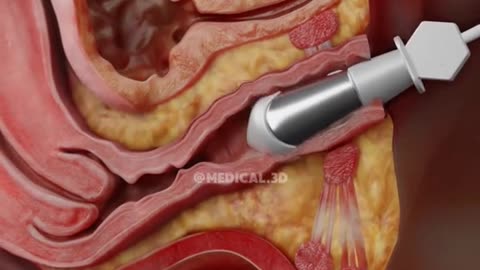 What is V-Tone Procedure and How It Works (3D Animation)