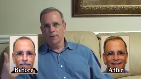 Dr. Brett Bolton Hair Transplant Correction – Amazing Results