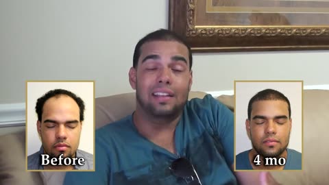 Dr. Brett Bolton Hair Transplant: Undetectable Scar