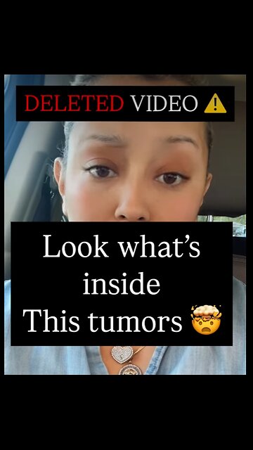 Colon Cancer Tumor- Really Filled With Parasites - graphic