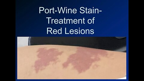 Laser Treatment of Port-Wine Stains