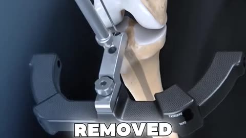 What Happens When You Fracture Your Tibia Bone