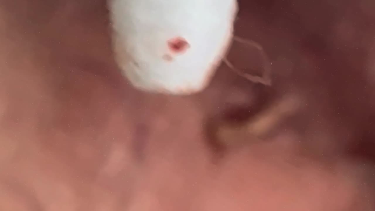Satisfying massive blackhead removal #1