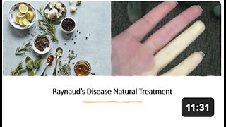 Raynaud's Disease Natural Treatment