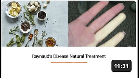 Raynaud's Disease Natural Treatment