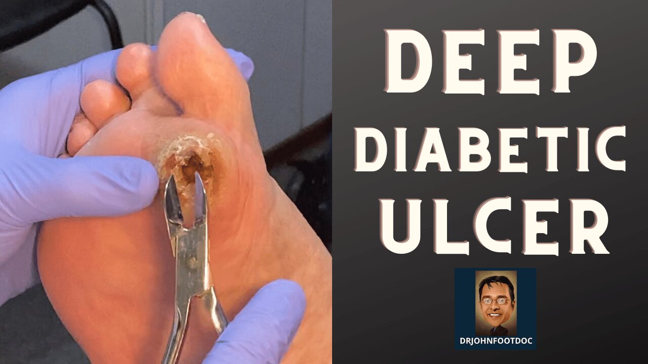 How to Cure Diabetic Ulcers Fast
