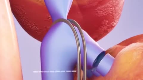 Complete Liver Transplant Procedure 3D Animation