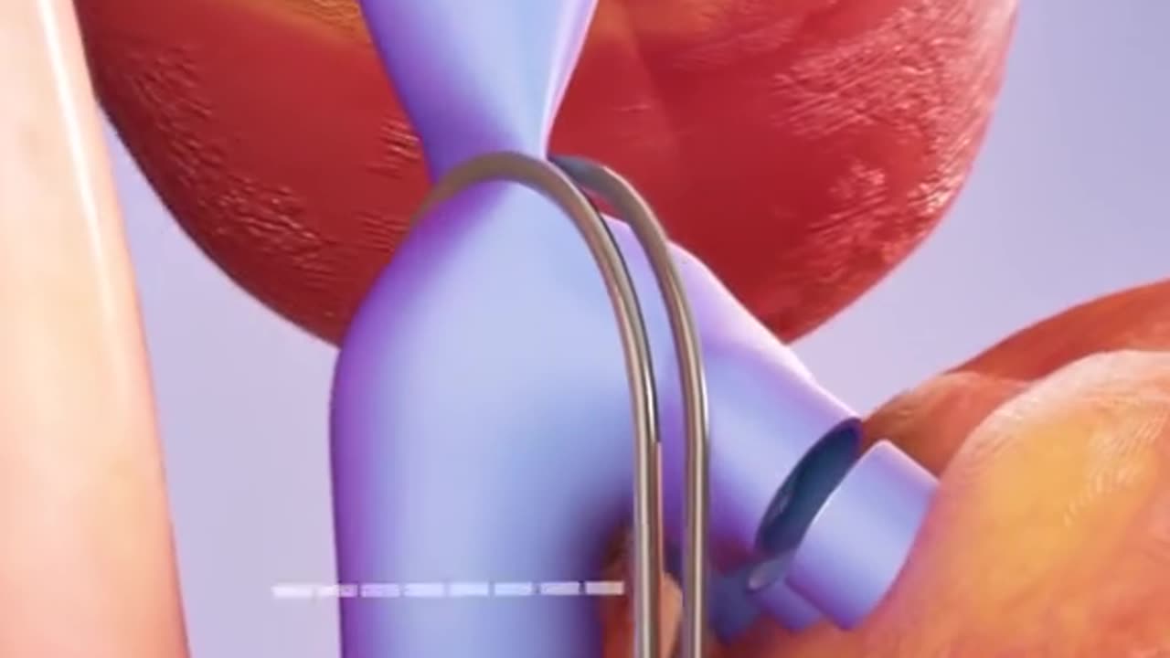 Complete Liver Transplant Procedure 3D Animation