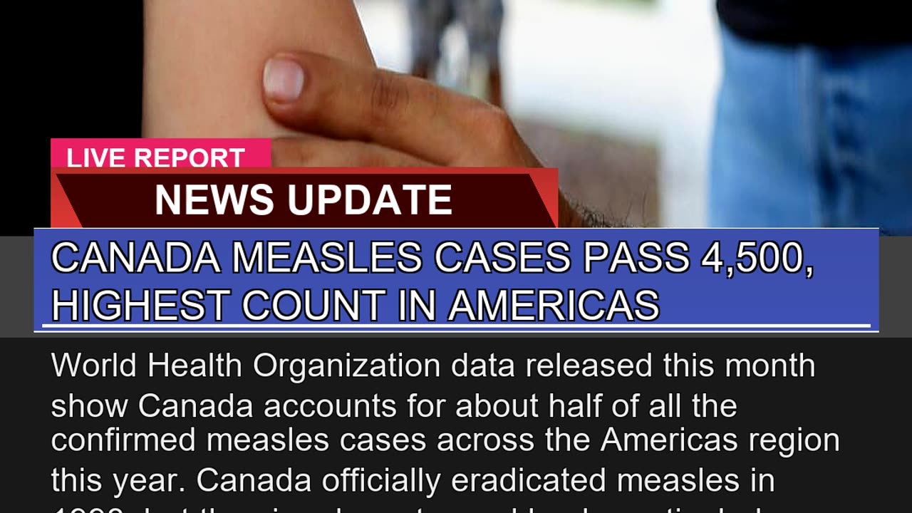 Canada Measles Cases Pass Highest Count in