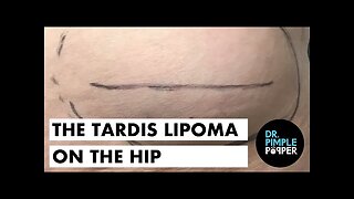 The Tardis Lipoma on the Hip
