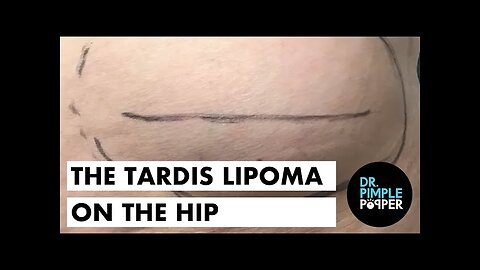 The Tardis Lipoma on the Hip