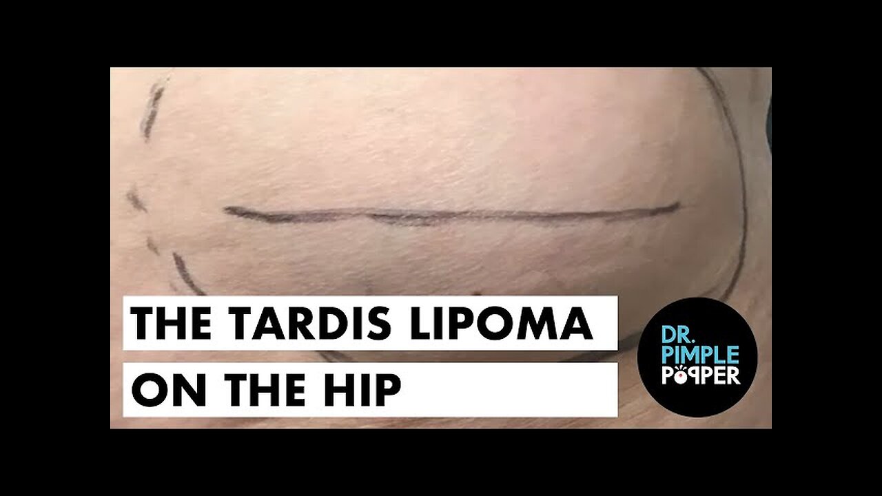 The Tardis Lipoma on the Hip