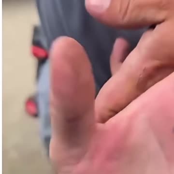 Pliers Pull Out Long Metal from Man’s Hand