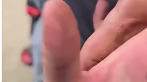 Pliers Pull Out Long Metal from Man’s Hand