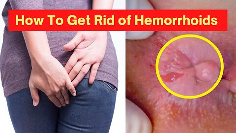 How To Get Rid of Hemorrhoids