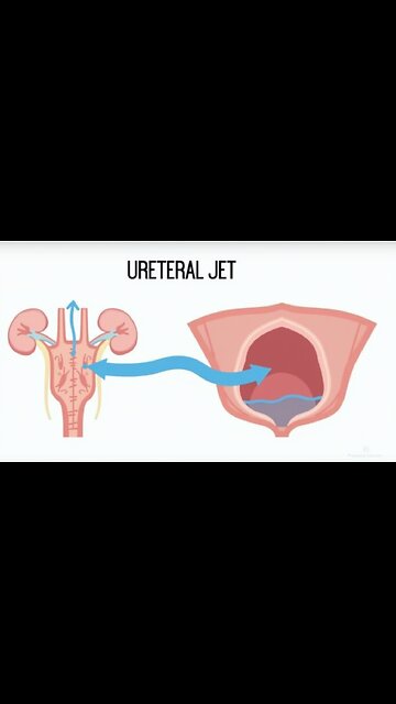 Ureter jetting urine into the bladder