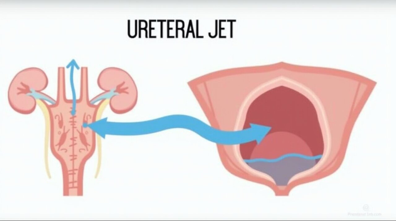 Ureter jetting urine into the bladder