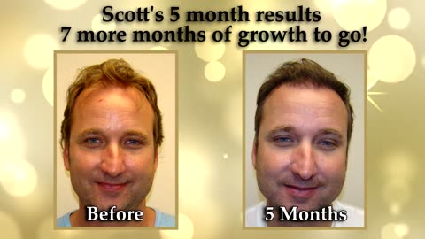 Dr. Brett Bolton Amazing Transformation of an Actor Who Restores his Hair and Gets New Role