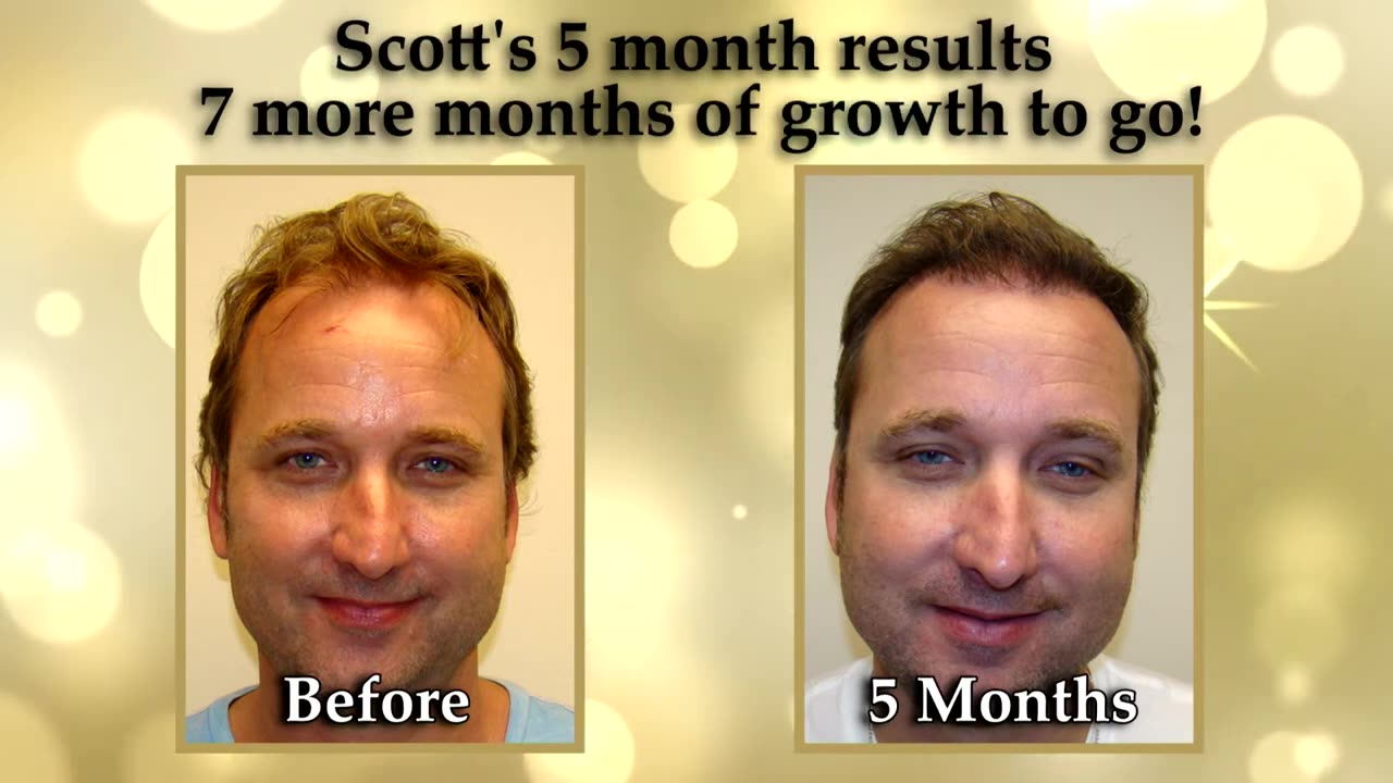 Dr. Brett Bolton Amazing Transformation of an Actor Who Restores his Hair and Gets New Role